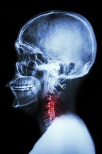 Nursing Home Spinal Injuries, Neck and Back Fracture