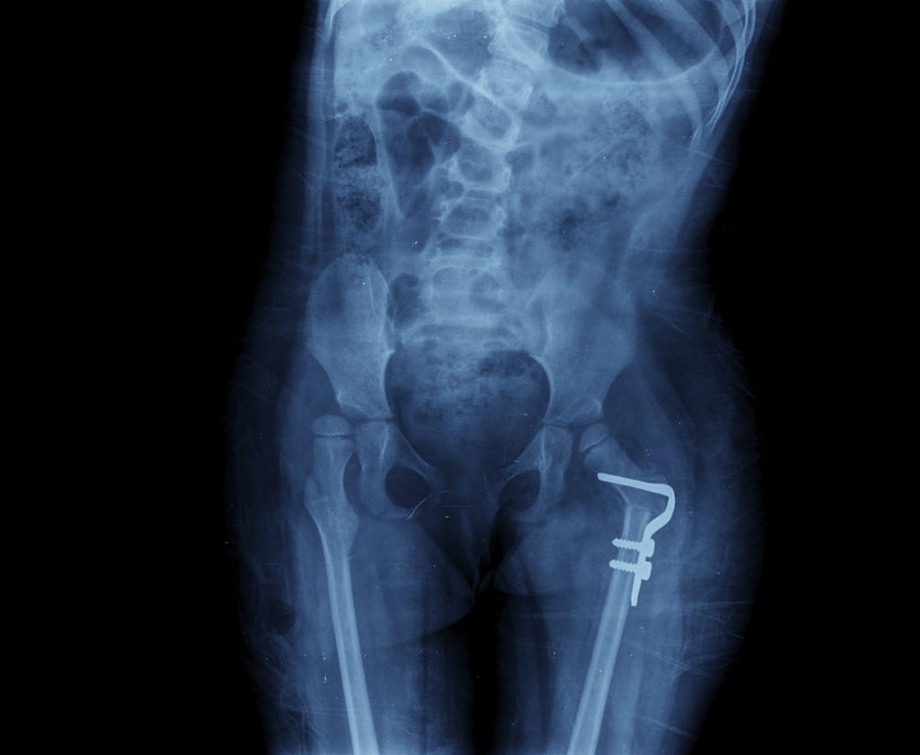 Failure to Supervise Resident at Hopkins Health Services after Wandering and Elopepment, Resident Fall with Fractured Hip