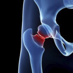 Hip Fracture Fall Injuries