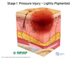 NPIAP Pressure Injury Stages