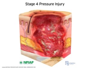 Stage 4 Pressure Ulcer Injury
